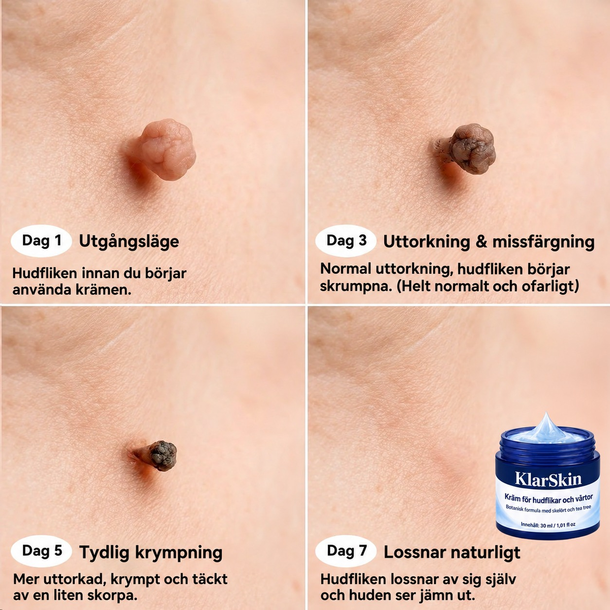 KlarSkin | Riktad kräm för hudflikar och vårtor, 30 ml