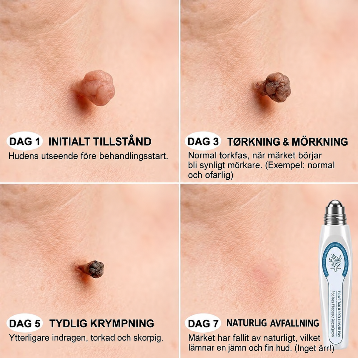 HudRoll | Roll-on serum mot vårtor och hudflikar, 15 ml